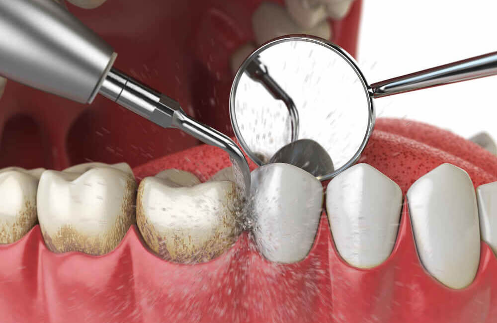 Dental implants treatment in Egmore